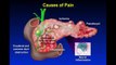 Chronic Pancreatitis | Alireza Sedarat, MD | UCLA Digestive Disease