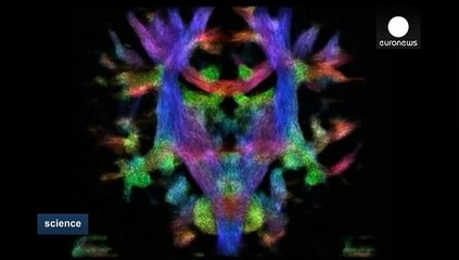 Mapping the unborn baby's brain to better combat disease