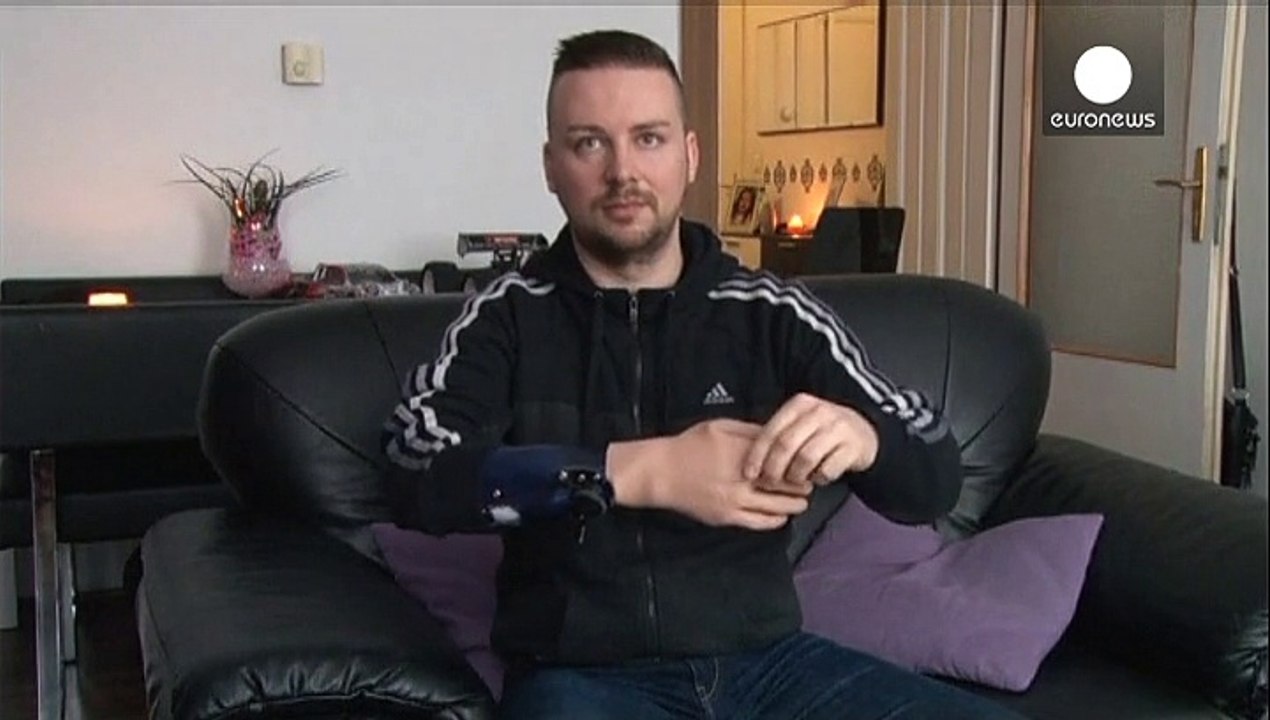 Bionische handprothesen, die funktionieren