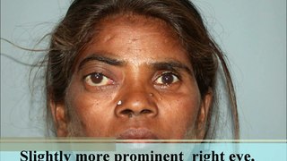 Proptosis | Exophthalmos| Cavernous Hemangioma| Lateral Orbitotomy Surgery in Mumbai, India