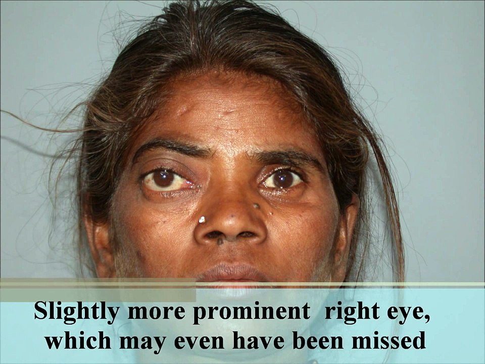 Proptosis | Exophthalmos| Cavernous Hemangioma| Lateral Orbitotomy Surgery in Mumbai, India