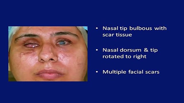 Rhinoplasty, Nose Job Surgery (Septoplasty/ Deviated Septum) in Mumbai, India- Dr. Debraj Shome