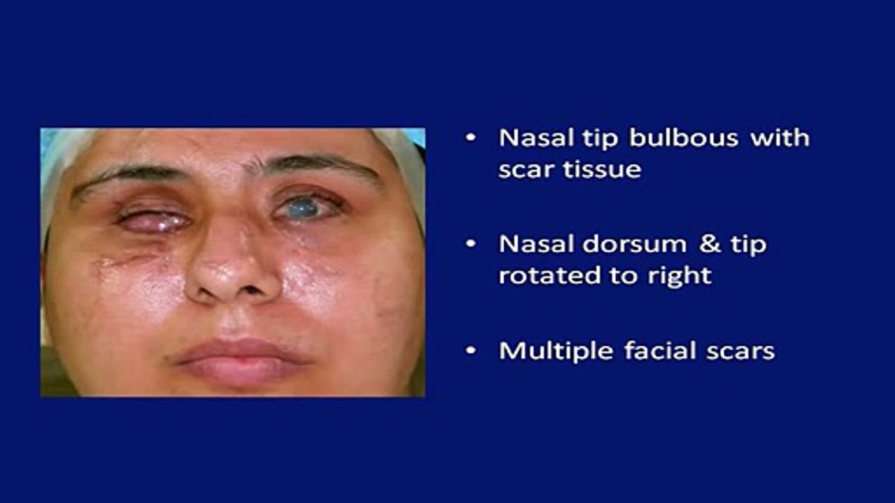 Rhinoplasty, Nose Job Surgery (Septoplasty/ Deviated Septum) in Mumbai, India- Dr. Debraj Shome