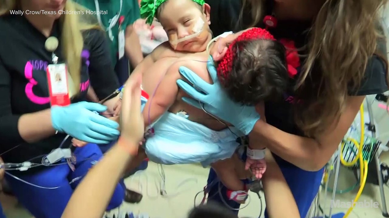 Conjoined twins survive 26-hour separation surgery