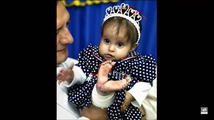 Baby Born as 'Little Mermaid' Recieves a Miracle