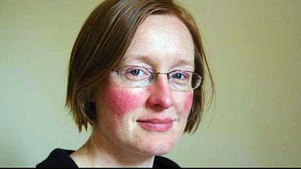 caper cream for rosacea