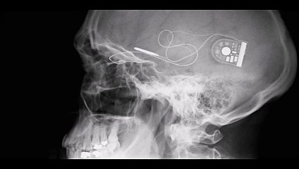 L'armée US envisage d'implanter une carte-mémoire dans votre cerveau