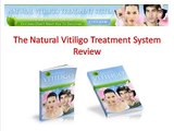 Natural Vitiligo Treatment System Review - See This Before You Buy!