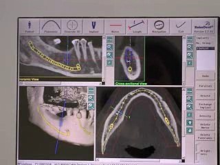 Robotique implantaire : démonstration du YeungSystem