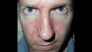 Healing Rosacea and Sensitive Skin Holistically