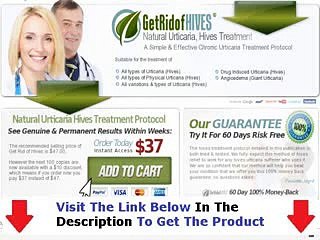 Get Rid Of Hives Shocking Review Bonus + Discount