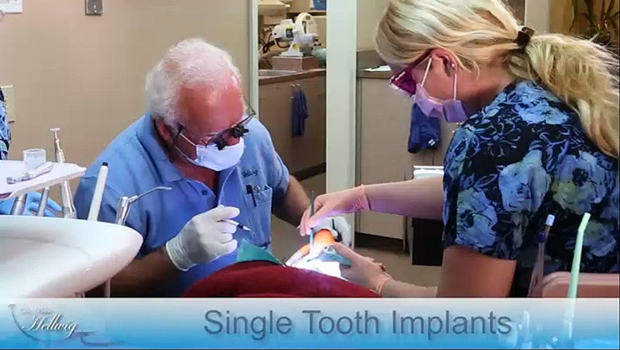 Single Tooth Implants - San Diego, CA - Dr. Peter Hellwig