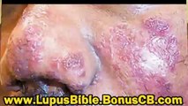 The lupus bible - lupus treatment - Lupus cure - Lupus holistic treatment