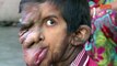 Facial Tumour: Community Rallies To Give Boy New Hope 