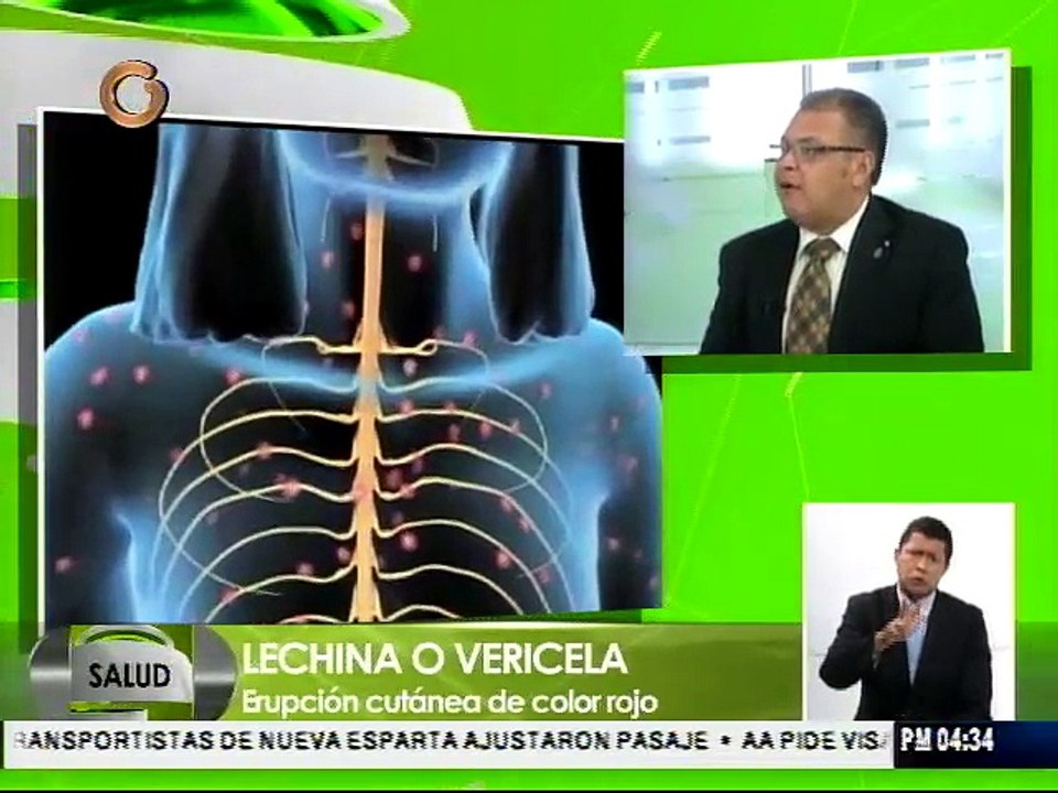La varicela es una enfermedad benigna y poco frecuente en adultos