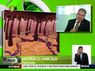 Venezuela, único país del sur donde a la varicela se le llama lechina