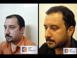 Hair Transplant Videos in Pakistan,Hair transplant clinic Lahore Pakistan