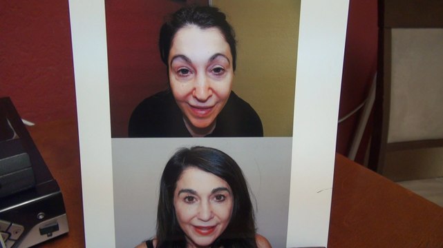 Woman Eyebrows Hair Loss Transplant Restoration Surgery 12 Months Result Dr. Diep mhtaclinic.com