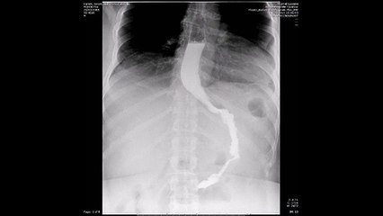 SASI bypass gastrograffin