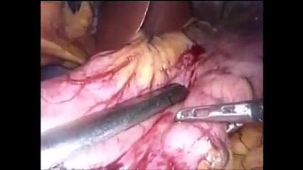 Laparoscopic single anastomosis sleeve illeal bypass SASI Bypass By Tarek Mahdy