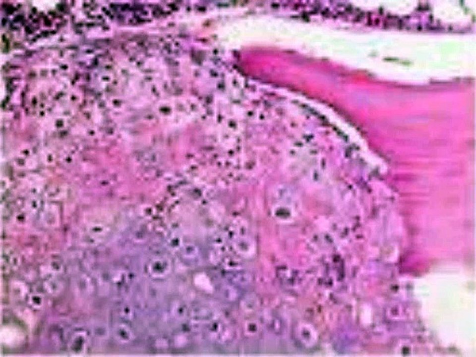 megaloblastik anemi nedir,pernisioz anemi,megaloblastik anemiler,megaloblastik anemi belirtileri,megaloblastik anemi ppt,megaloblastik anemi laboratuar,megaloblastik anemi laboratuvar bulguları,megaloblastik anemi pdf