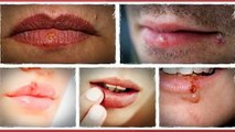 Get Rid Of Cold Sores Fast Review-Home Remedies For Cold Sores