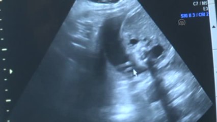 Anne Karnındayken Böbrek Yetmezliğinden Kurtuldu