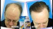Best hair loss treatment - How to stop hair loss and baldness cure