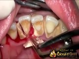 Aller chez le dentiste 10 ans après ne plus s'être brossé les dents ! Voici le résultat !