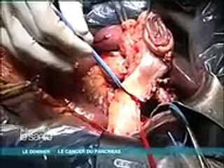 triệu chứng ung thư dạ dày