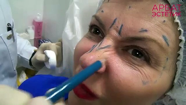 Ботокс До и После. Ботулинотерапия препаратом Диспорт (Dysport)