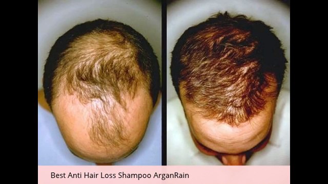 Natural Hair Oil Recipe for Hair growth,Damaged hair and Dandruff treatment