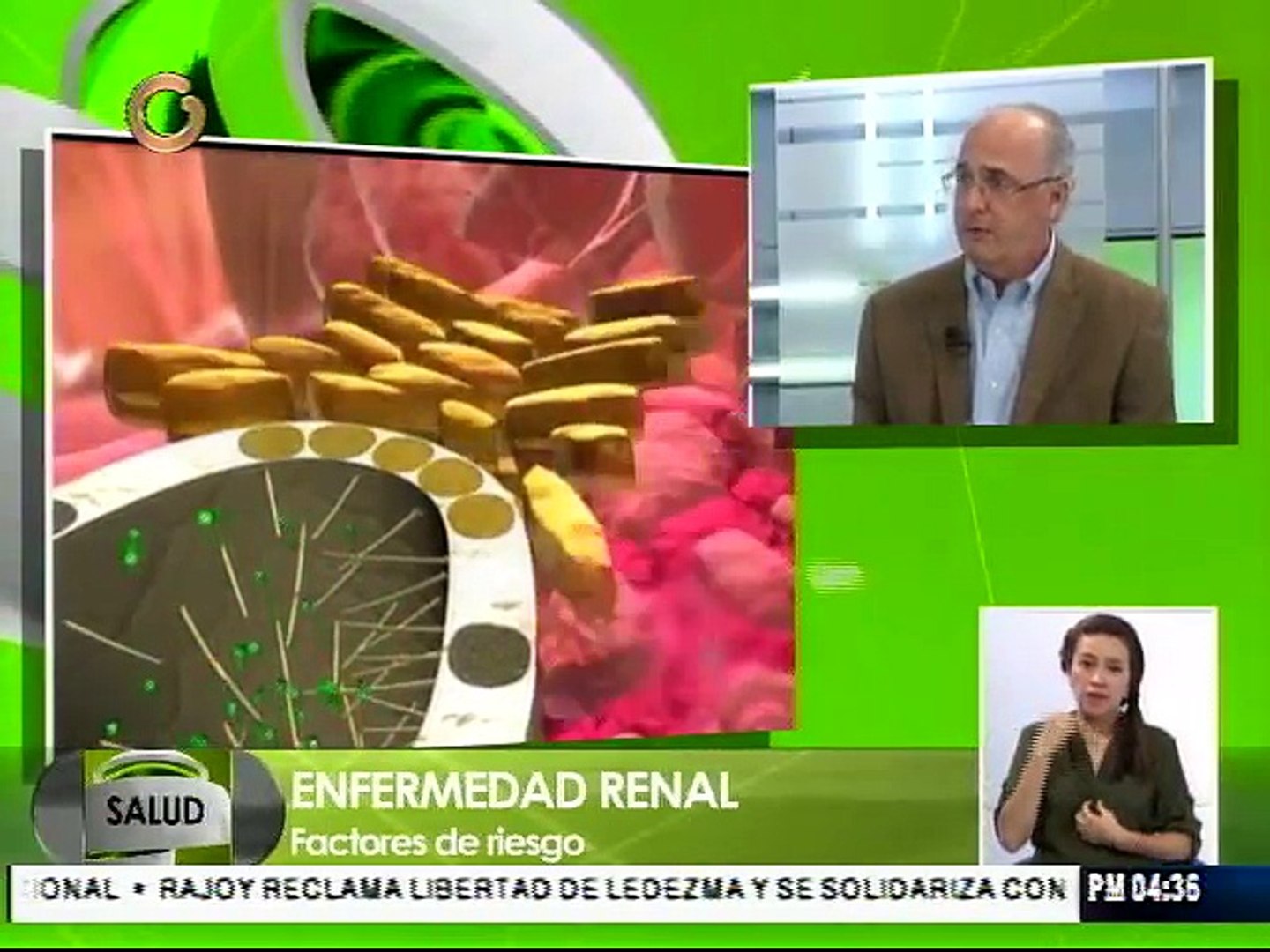⁣El cálculo renal es una afección frecuente
