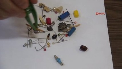 Sivas Nefes Borusuna Kaçan Cisim 20 Yıl Sonra Akciğerinden Çıkarıldı