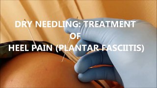 DRY NEEDLING TO TREAT PLANTAR FASCIITIS ( PHYSIOREVIVE)
