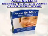 Acne Treatment Suffer Acne No More With Natural Treatments For Acne