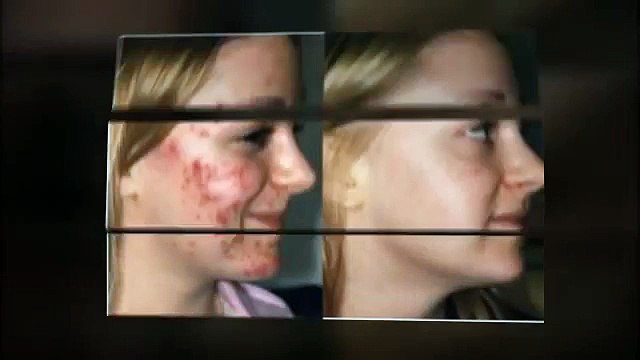 Nie Mehr Akne - Mein Nie Mehr Akne Buch Erfahrungen