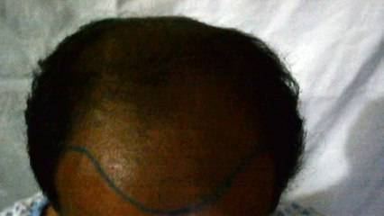 Fue hair transplant in Pakistan