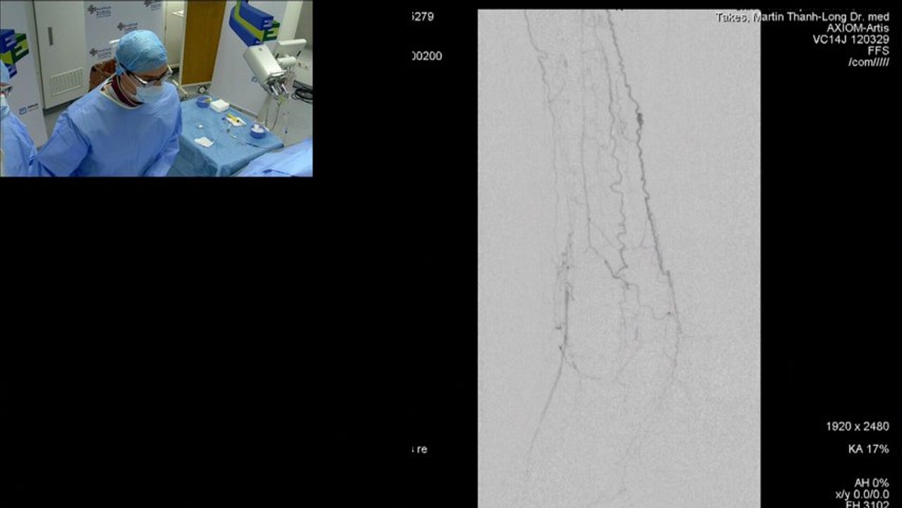 Severe popliteal and BTK occlusions in Buerger's disease. No reflow result