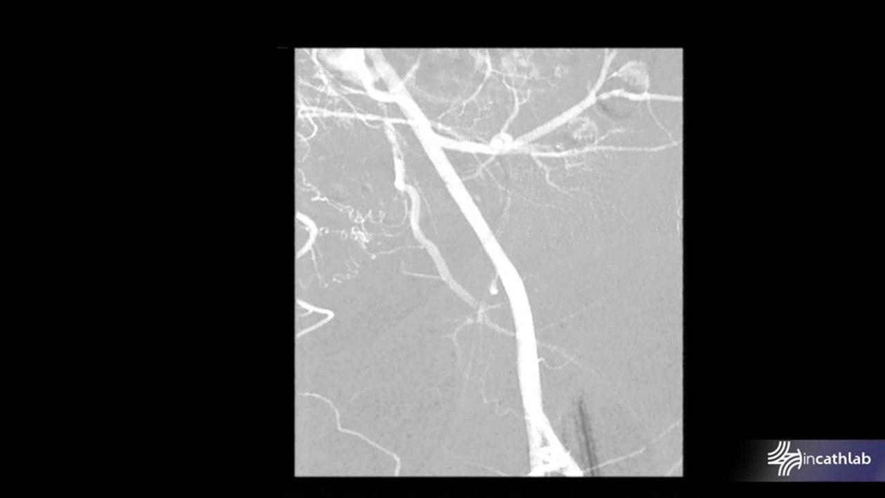 Bilateral iliac artery restenosis. ATRIUM Covered stent