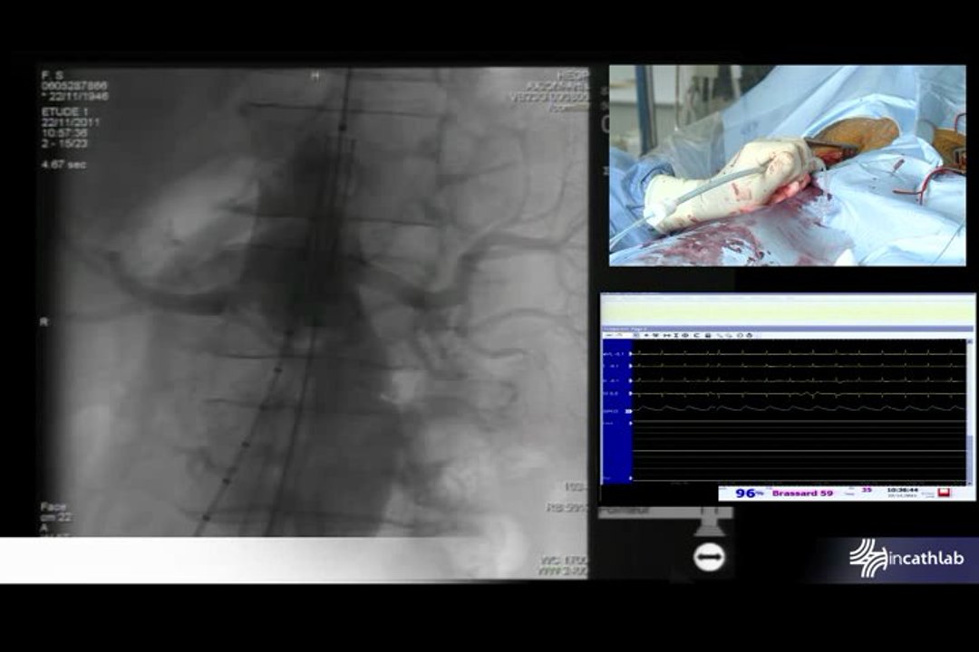 Seta Endoprothesis for Abdominal Aorta Aneurysm(1/5)