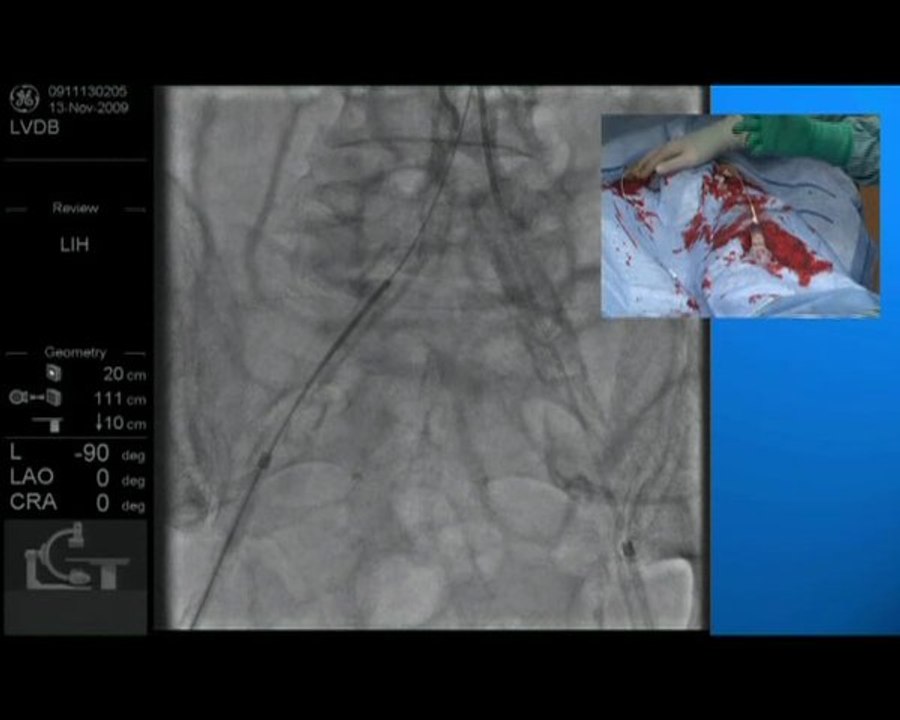 Endovascular Treatment of Iliac TASC C Lesion . Common Iliac Artery Recanalization