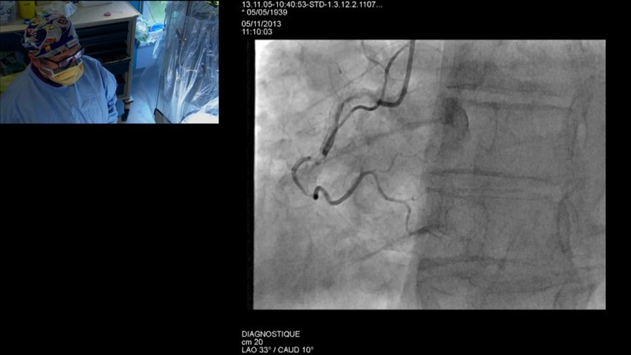 5 F Right Transradial approach in a patient with severe angina