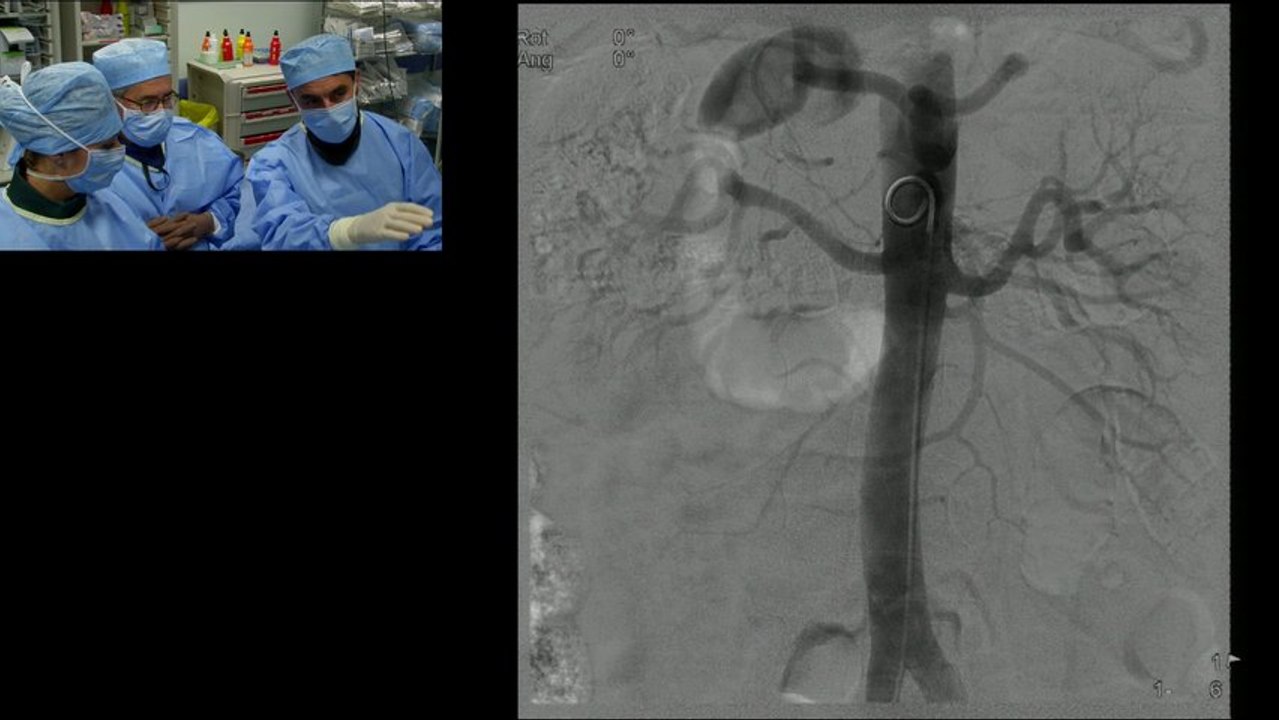 Aborted case of Renal artery denervation - A contra indication Fibrodysplasia
