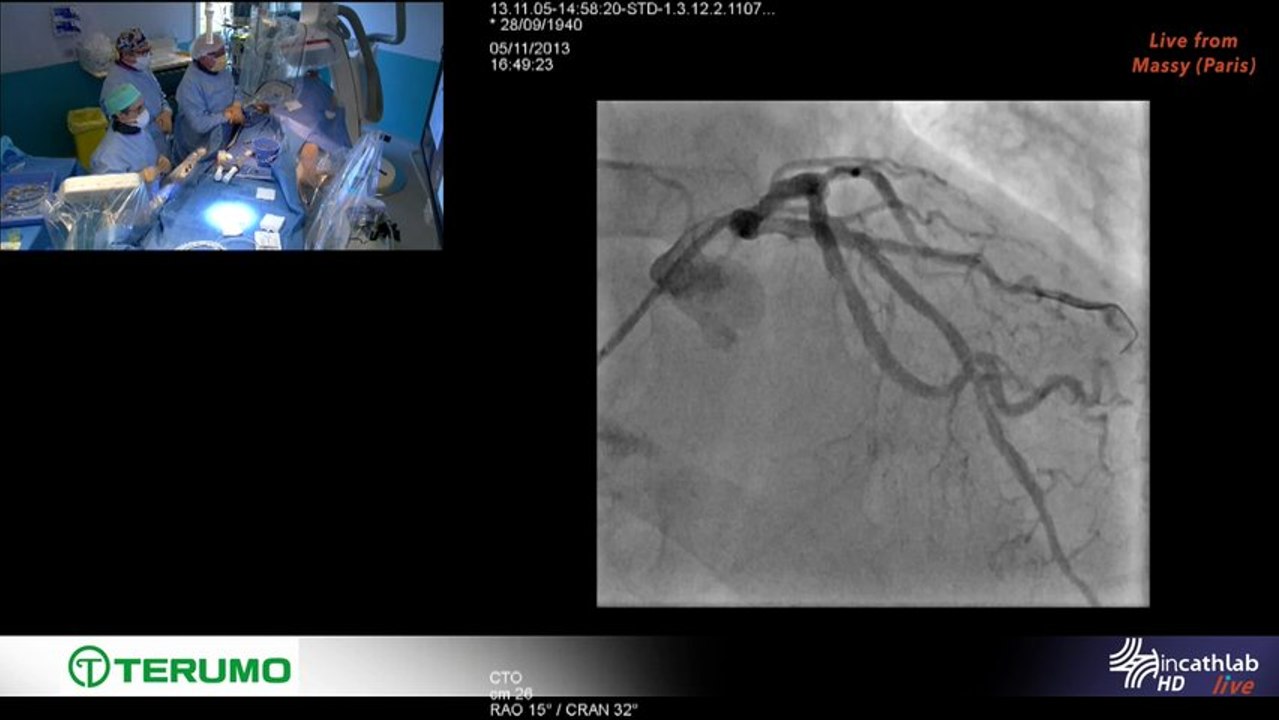 4 F Right Transradial approach in a 39Kg patient