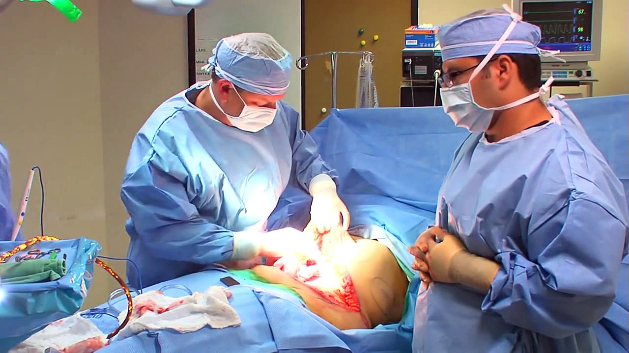 Tummy Tuck (Abdominoplasty) Surgery [Dr. Michael Kelly]