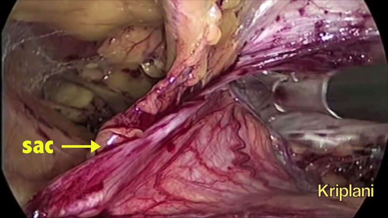 Laparoscopic TAPP Inguinal (groin) Hernia Repair  : The Indirect Sac