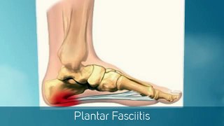 Plantar Fasciitis - Limerick Pain Relief and Sports Injury Clinic