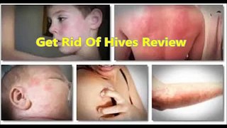 Get Rid Of Hives - Get Rid Of Hives Review