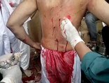 Zakir Attash Abbas Having Stitchis After Zanjeer Zani
